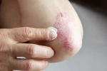 Skin disorders news, Skin disorders symptoms, five common skin disorders and their symptoms, Health problems